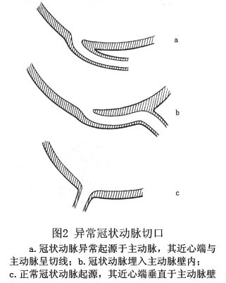 冠状动脉异常起源主动脉