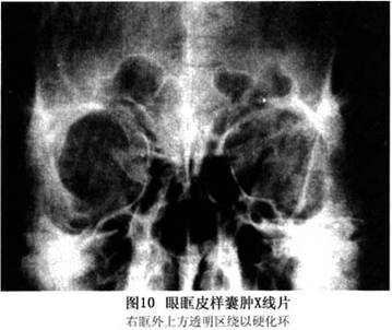 x线检查  较大的眼眶皮样囊肿在标准克氏位(20