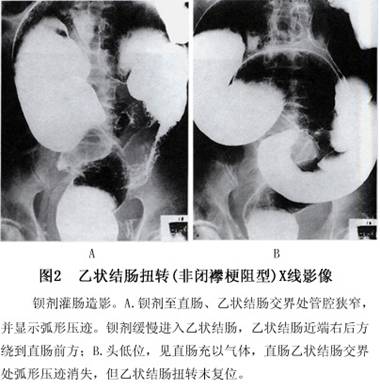 乙状结肠扭转