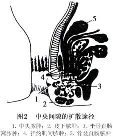 组织内形成脓肿或破溃;向外穿过外括约肌至坐骨直肠窝形成坐骨直肠窝