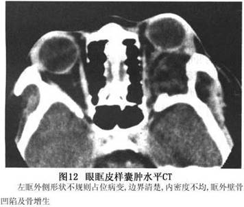 眼眶皮样囊肿