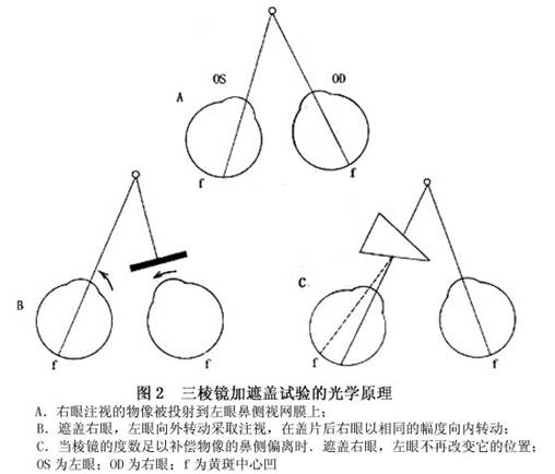 隐斜详情页,隐斜哪家医院看得好|治疗隐斜哪个医生好|隐斜推荐医院医