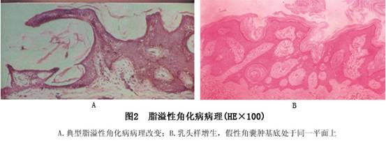 组织病理检查,可见表皮角化过度,棘层肥厚和乳头瘤样增生(图2.