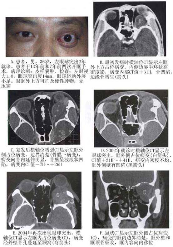 眼眶皮样囊肿