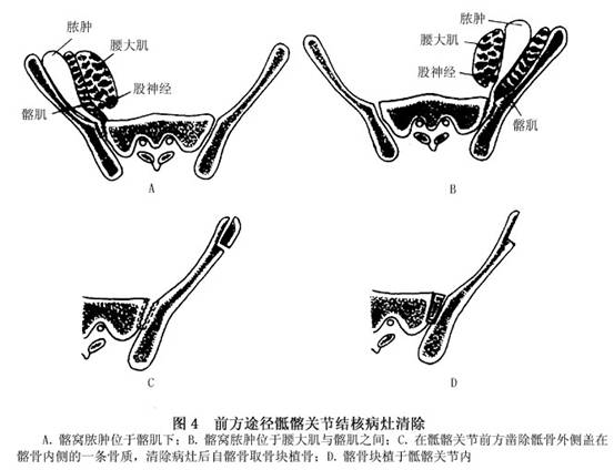 骶髂关节图片