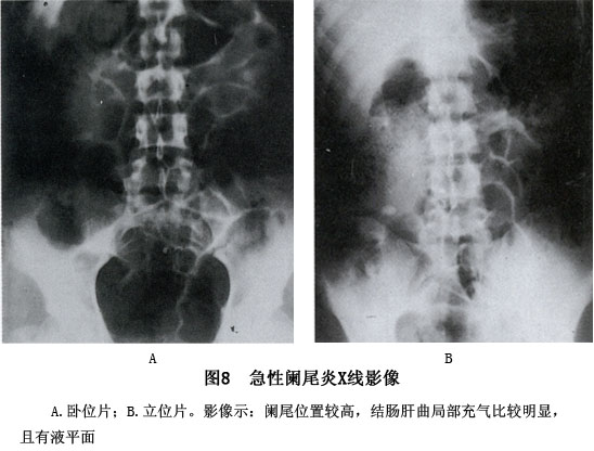 急性阑尾炎