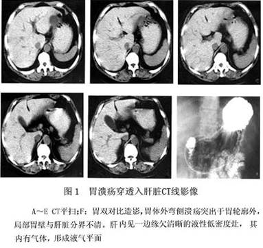 2.纤维内镜  见深的溃疡(龛影)可疑穿透性.