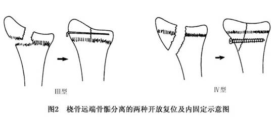 桡骨远端骨骺分离