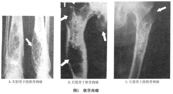 软骨肉瘤