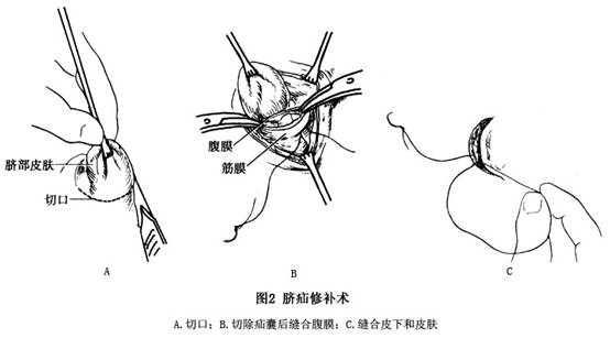 小儿脐疝