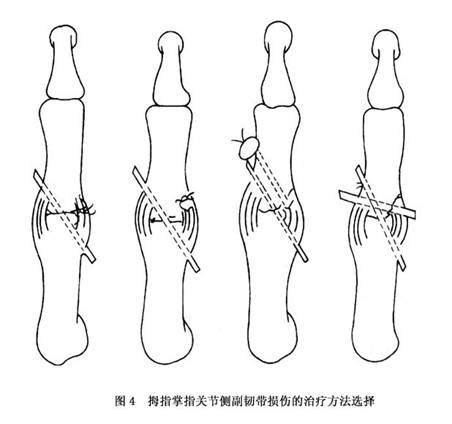 拇指掌指关节尺侧侧副韧带损伤
