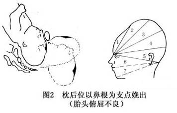 (2)胎头俯屈不良:胎儿额部先露于耻骨联合下方,逐渐娩出鼻根部,以