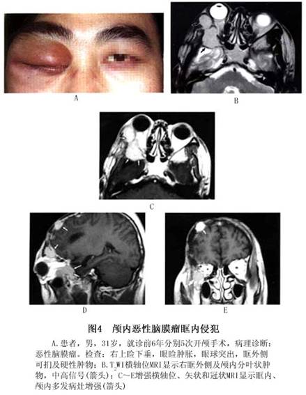 蝶骨嵴脑膜瘤眼部病变