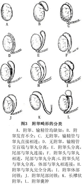 附睾畸形