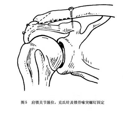 用2枚克氏针从肩峰端钻进锁骨末端3～4cm,克氏针尾弯成弧形埋入皮下.