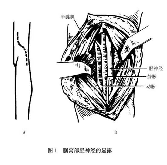 胫后神经损伤