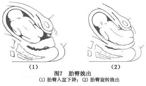 随宫缩的加强,入盆时胎儿股骨大粗隆间径,衔接于骨盆左斜径,胎臀逐渐