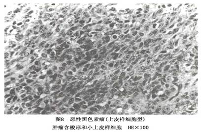 疾病介绍     来源于痣的恶性黑色素瘤,对恶性黑色素瘤标本作连续切片