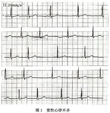 小儿窦性心律不齐