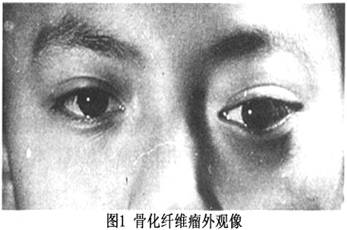 眼眶骨化纤维瘤