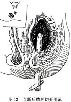 (4)直肠后脓肿:切开引流与坐骨直肠窝脓肿基本相同,但其切口更