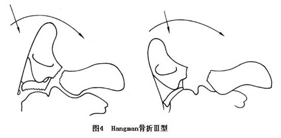 创伤性枢椎滑脱