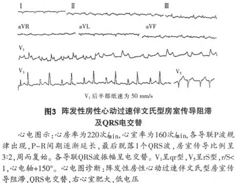 房性心动过速伴房室传导阻滞