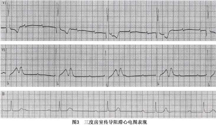 老年人心脏传导阻滞