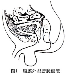 膀胱破裂按破裂口与腹膜位置关系,又可分为3类(1)腹膜外型膀胱