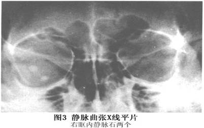 x线检查  多数正常,约1/4发现静脉石(图3),幼年开始患病者眶腔扩大及