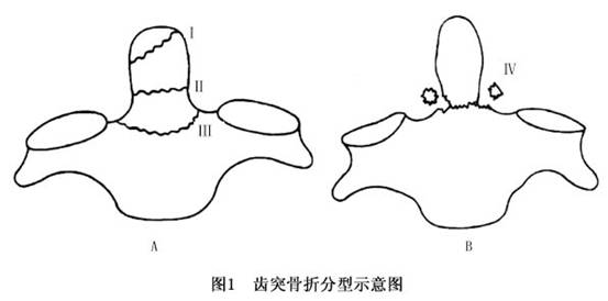 枢椎齿突骨折