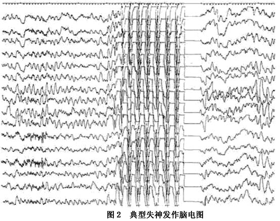 全面性发作