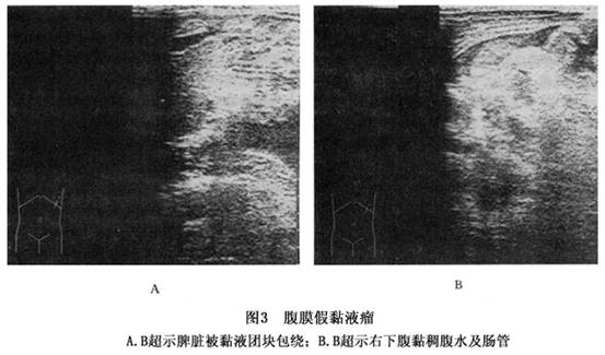 腹膜假黏液瘤