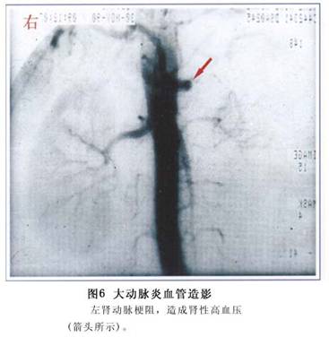 大动脉炎