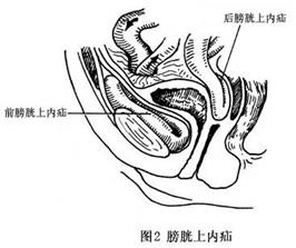 膀胱后方,男性与直肠相邻,女性与子宫及阴道前壁相邻,其间为膀胱后