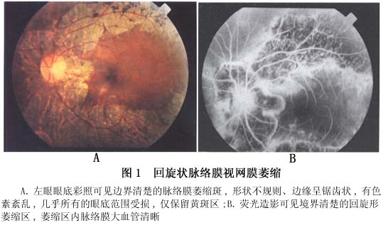回旋状脉络膜视网膜萎缩