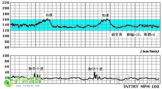 是应用胎心率电子监护仪将胎心率曲线和宫缩压力波形记下来供临床分析