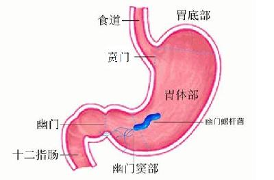 全球约一半人感染的幽门螺杆菌