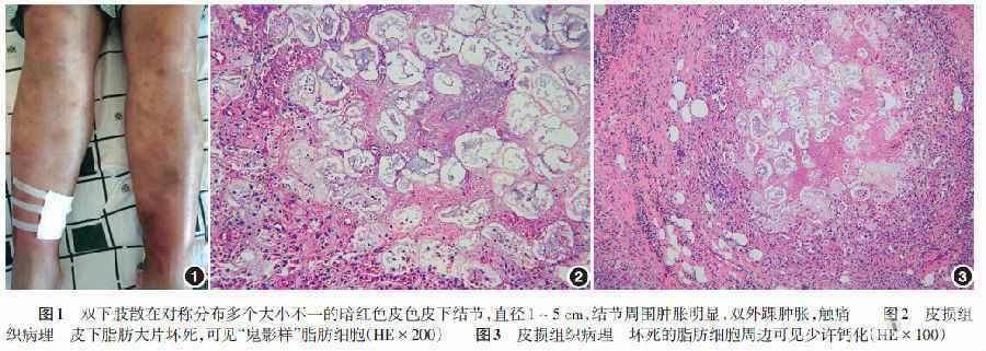 疑难病例:胰腺性脂膜炎一例