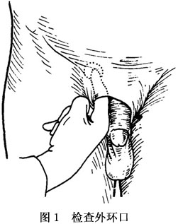 症状     (1)腹股沟部肿块:腹股沟斜疝的重要临床表现是腹股沟部有一