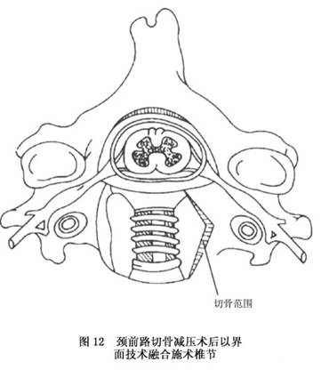 神经根型颈椎病详情页,神经根型颈椎病哪家医