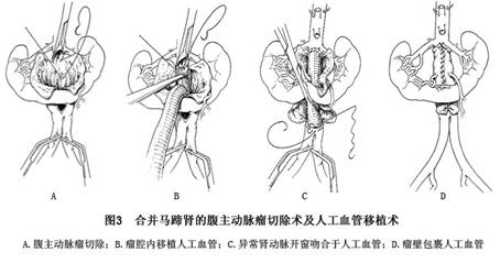 合併馬蹄腎的腹主動脈瘤哪家醫院看得好|治療合併馬蹄腎的腹主動脈瘤