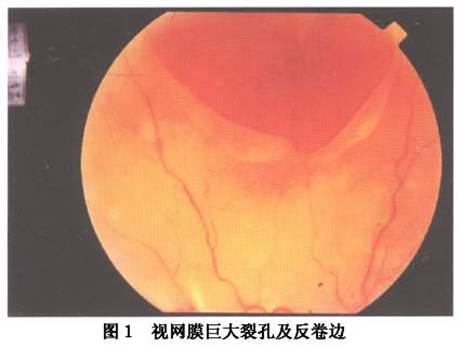 视网膜巨大裂孔属于撕裂孔