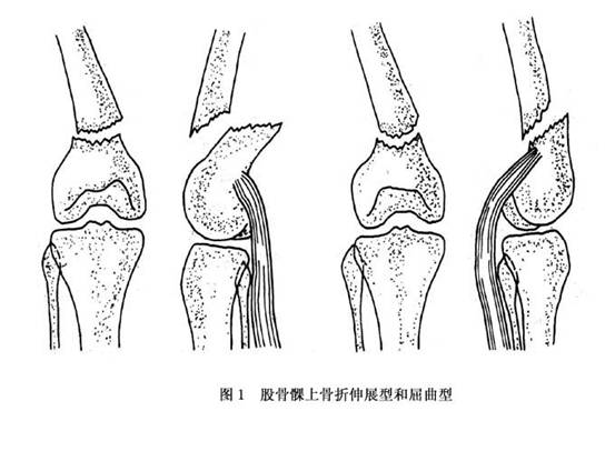 股骨髁上骨折分型图图片