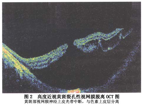 若黄斑区视网膜脱离程度不高,oct检查可以清楚地显示裂孔及玻璃体的