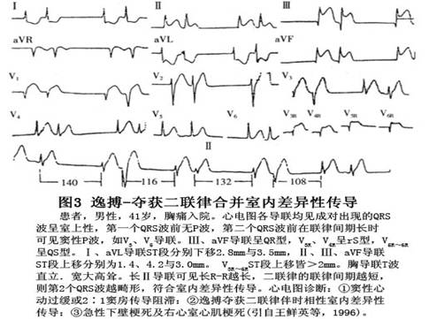 逸搏心律什么意思图片