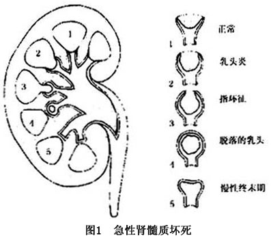 肾髓质坏死