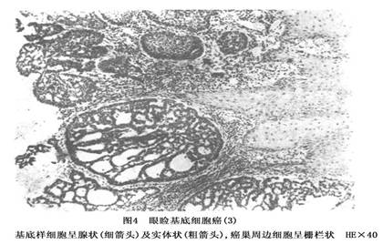 眼睑基底细胞癌概述 病因 诊断 治疗 预防 微医 挂号网