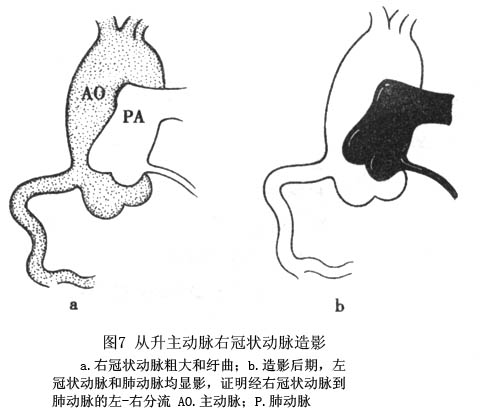 冠狀動脈異常起源於肺動脈