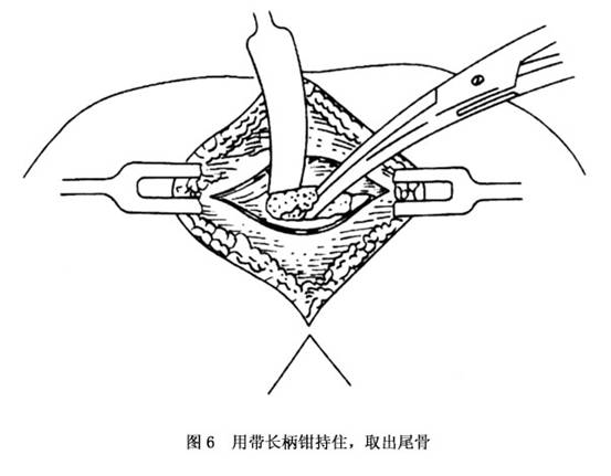 尾骨骨折与脱位概述 病因 诊断 治疗 预防 微医 挂号网